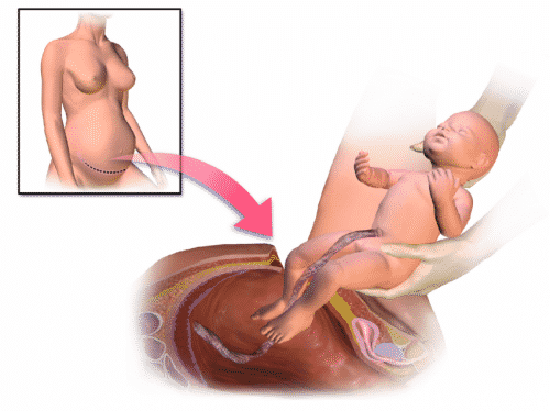 parto cesareo